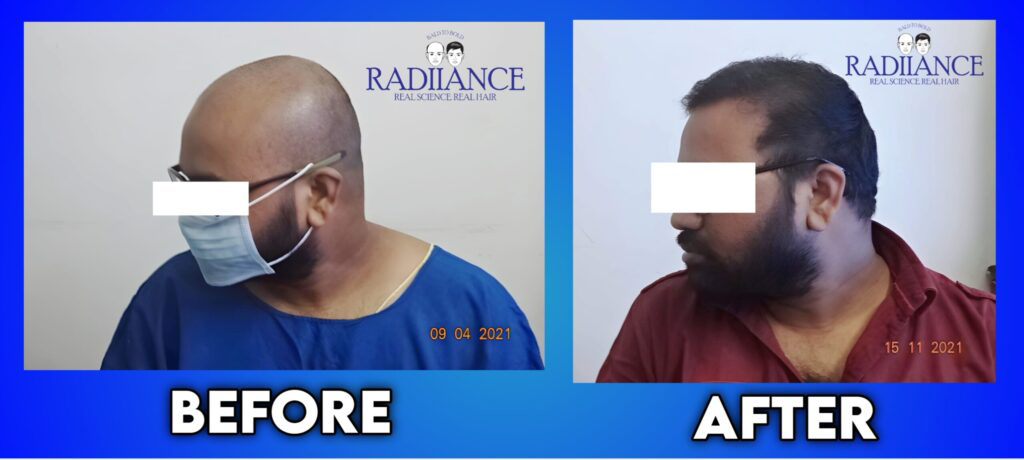 Radiance Hair Transplant Clinic