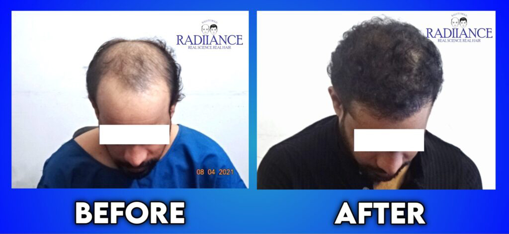 Radiance Hair Transplant Clinic