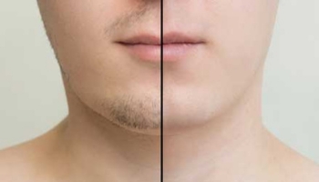 hair plantation in rajahmundry