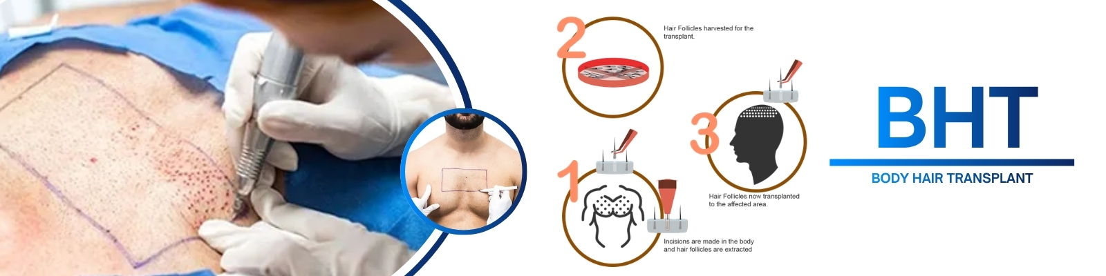 Body Hair Transplant Clinic in hyderabad