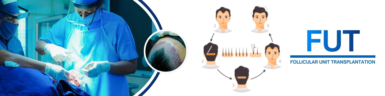 FUT Hair Transplant Center in Hyderabad