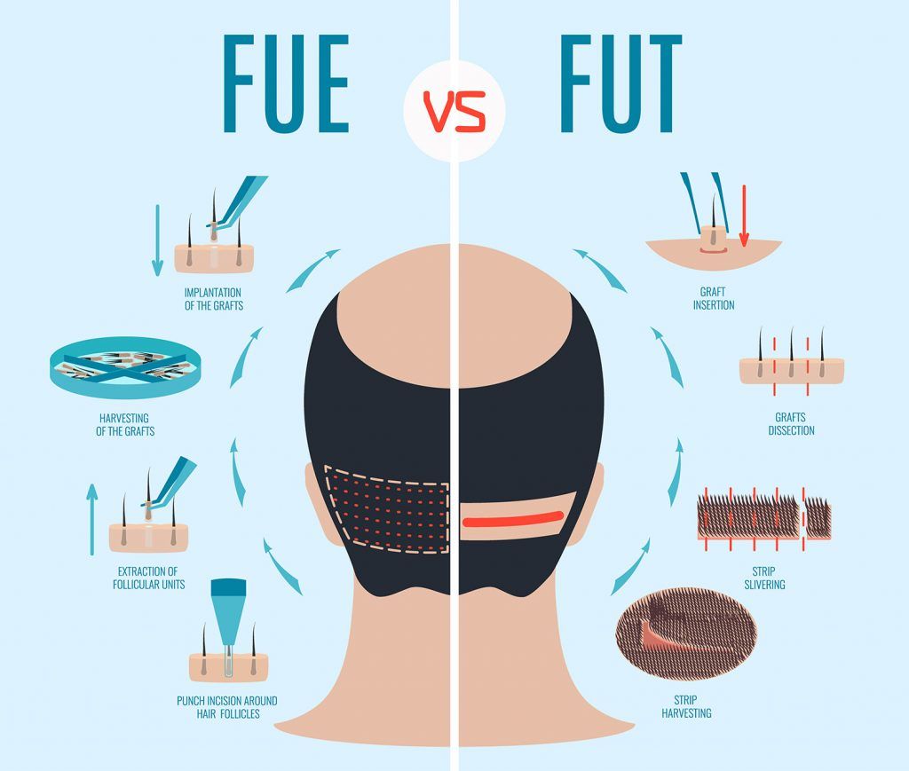 Hair Transplant Technique