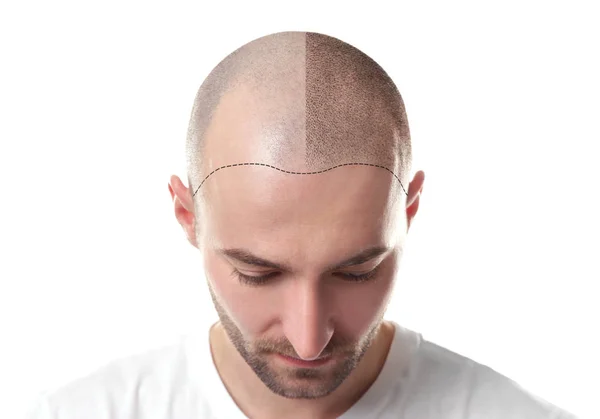 What to Expect Before, During, and After Your Hair Transplant Surgery
