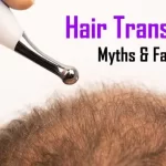 Hair-Transplant-Myth-in-hyderabad