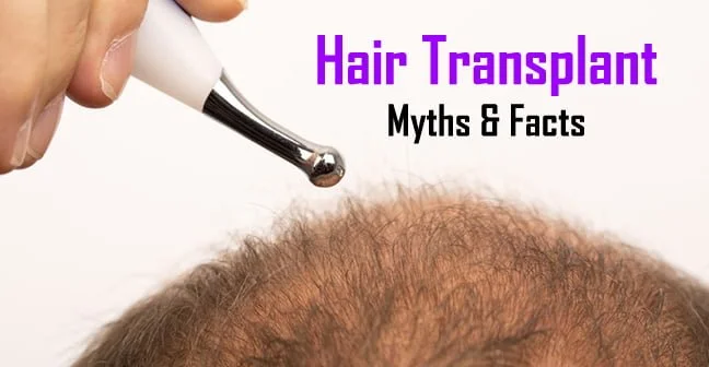 Hair-Transplant-Myth-in-hyderabad