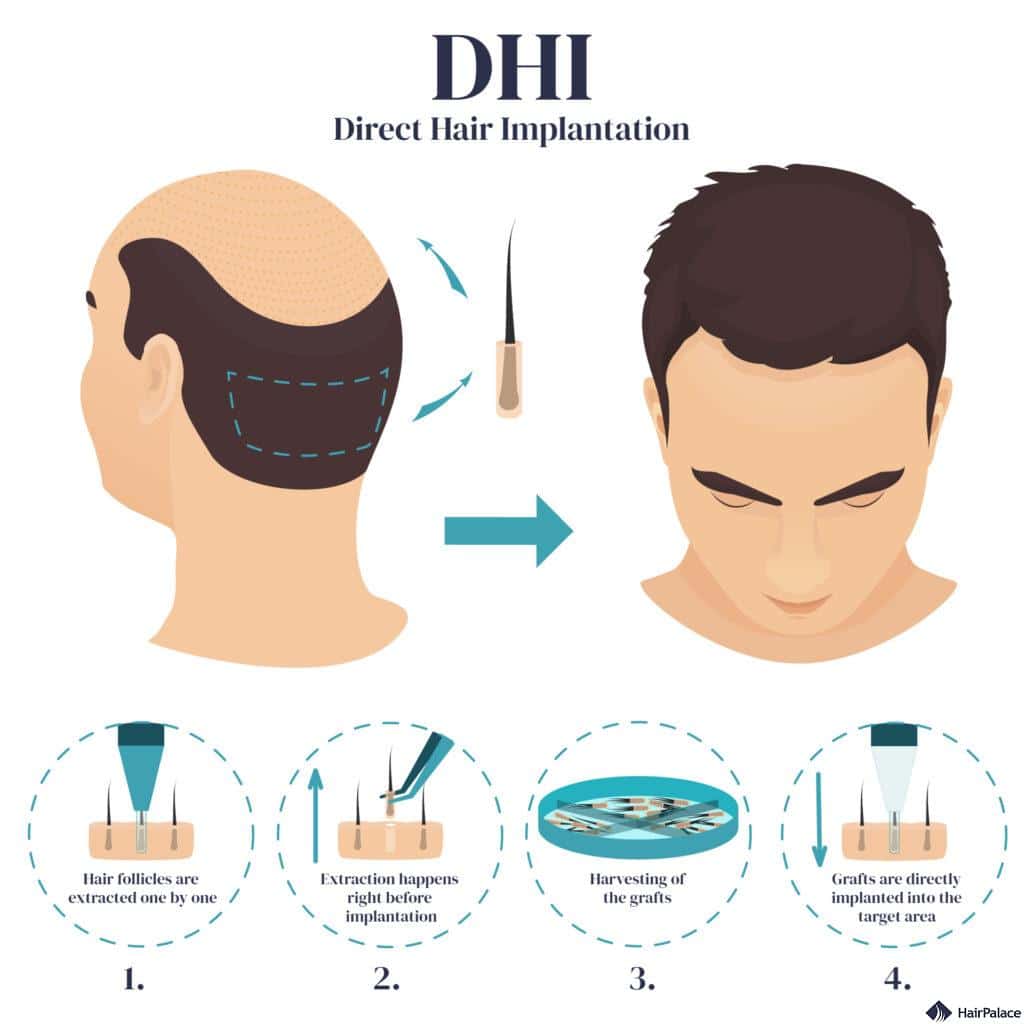 hair-transplantation-in hyderabad
