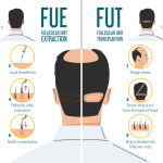 FUE vs FUT