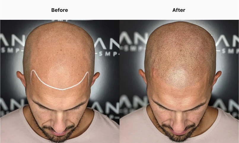 Best Hair Transplantation in Hyderabad