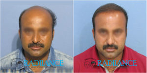 Radiance hair transplant center customers before and after images