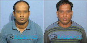 Radiance hair transplant center customers before and after images