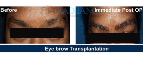 radiance eyebrow hair transplant treatment