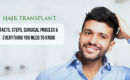 hair transplant treatment